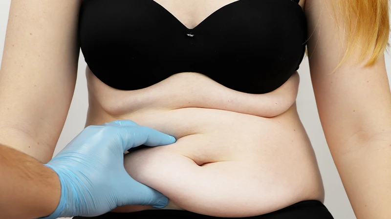 Vaser 4D Liposuction in Dubai for Slimmer Shape