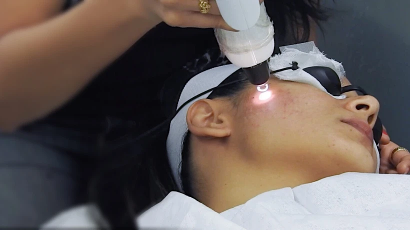 Can Laser Treatments Help Reveal Naturally Healthier Skin?