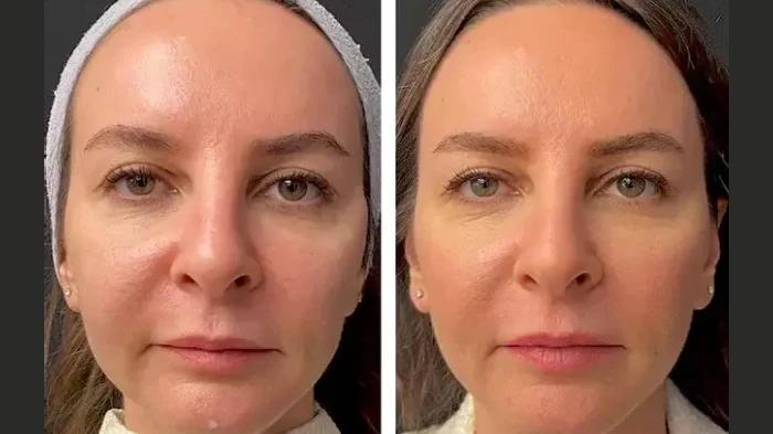 Mesotherapy for Pigmentation at the Best Aesthetic Clinic in Dubai