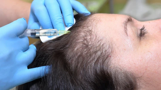 Which Hair Problems Can PRP Hair Treatment Treat?