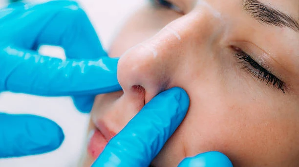 Comparing Open vs. Closed Rhinoplasty Methods in Riyadh
