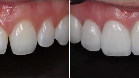 Are Porcelain Veneers Safe for Your Teeth?