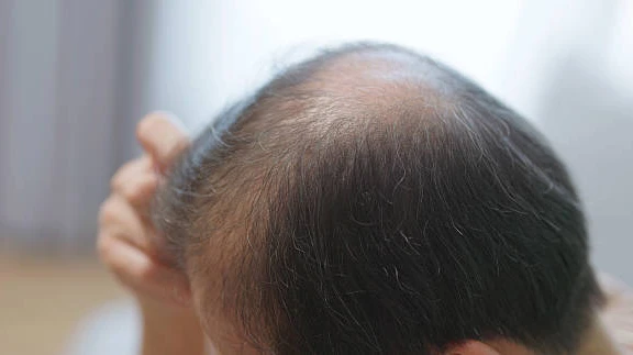 Exosomes Therapy for Hair Loss: Exploring Advanced Regenerative Care