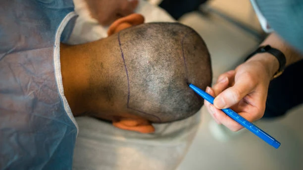 Is Scalp Micropigmentation Suitable for Dark Skin