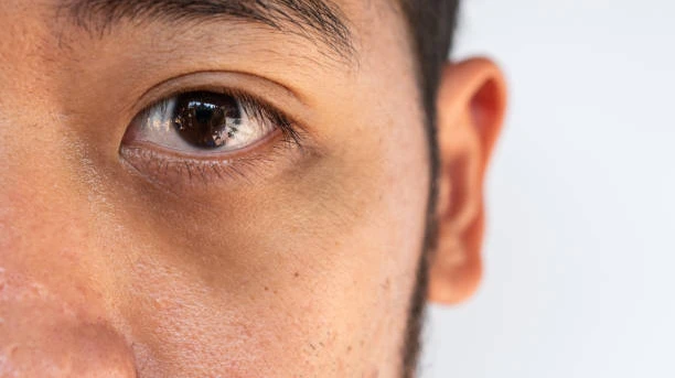 Which Dark Circles Treatment Works Best for Men