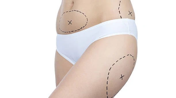 Does Lipo Abdominoplasty improve body confidence