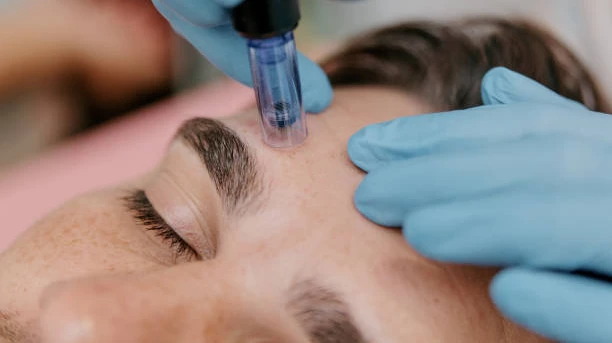 Can RF Microneedling smooth rough skin
