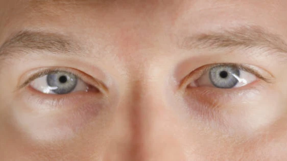 Eyelid Surgery for Addressing Excess Skin Around the Eyes