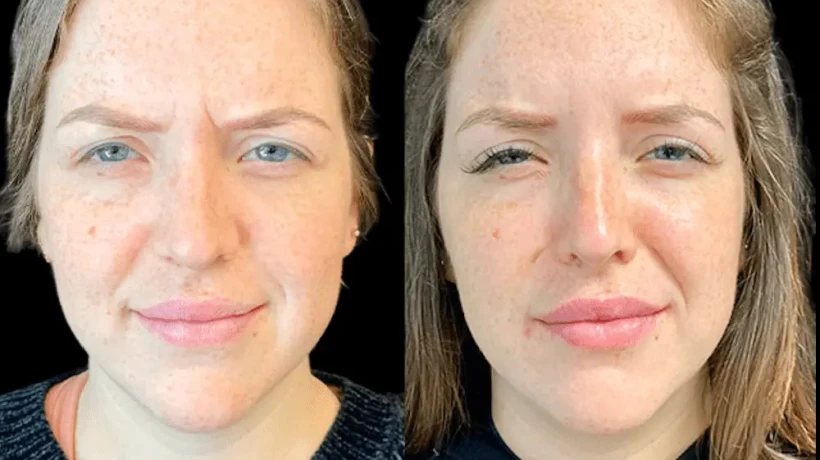 Best Doctors in Dubai for Botox: Understanding Botox Treatment and Results