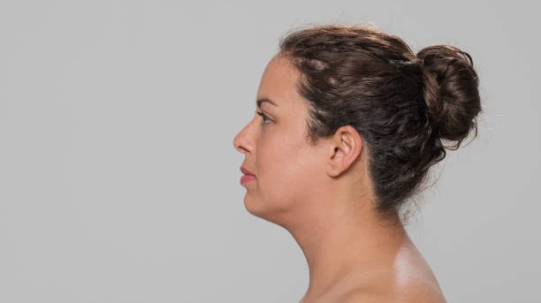 Expert Surgeons for Buffalo Hump Removal in Riyadh