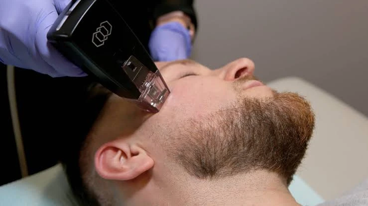 Is Morpheus8 Treatment Still Worth It in 2026?