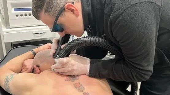 Is Laser Tattoo Removal Safe for Dark Tattoos?