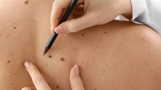 What Should You Know About Skin Lesion Removal?
