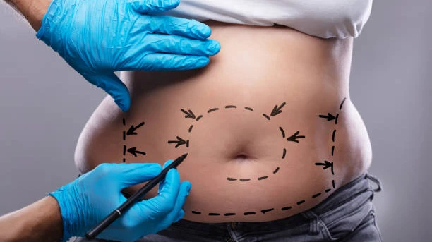 Is Liposuction suitable for post-pregnancy fat
