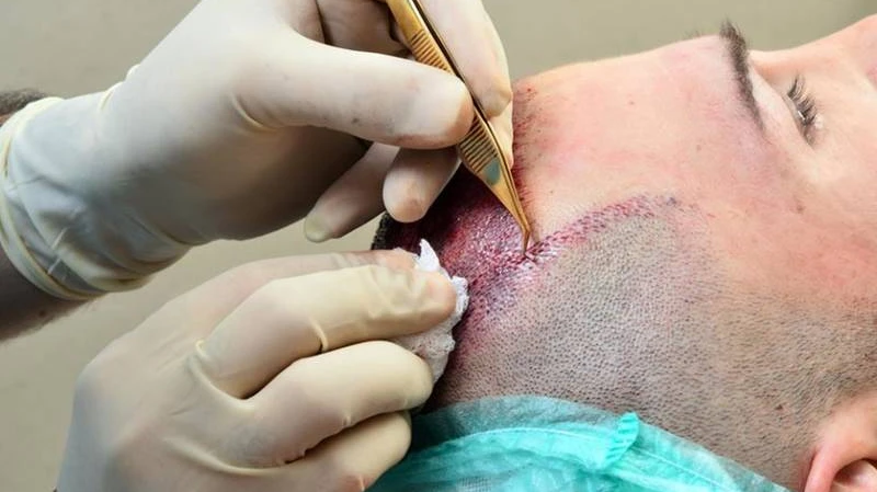 Can a Hair Transplant Add More Coverage to Sparse Areas?
