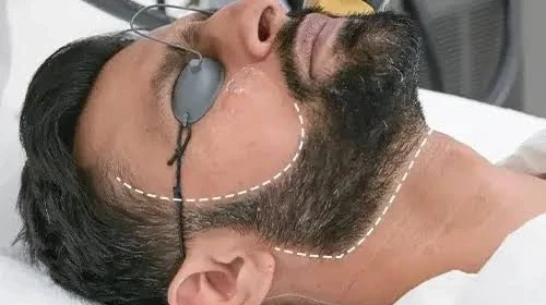 Does Beard Laser Hair Removal iHelp Uneven Growth?