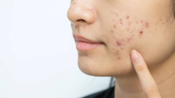 Is Laser Acne Scar Treatment safe for sensitive skin