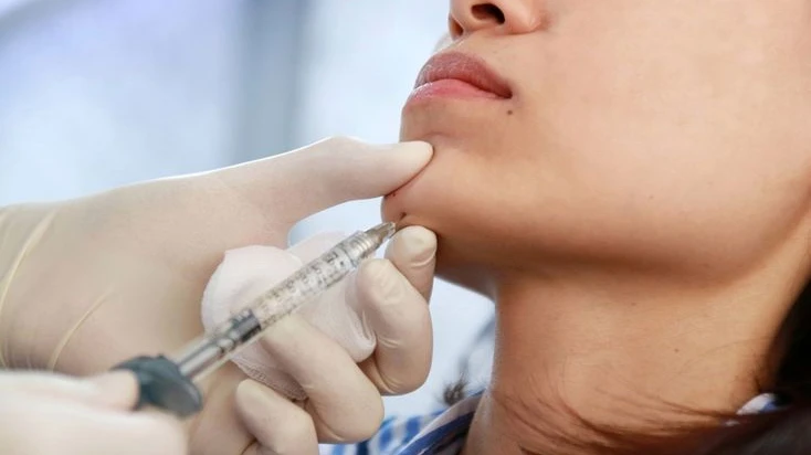 When Should You Consider Jawline Fillers Injections?