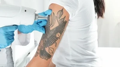 What Makes Laser Tattoo Removal a Popular Choice?