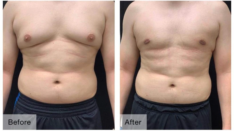 Gynecomastia Surgery Cost Breakdown Across Various Correction Techniques