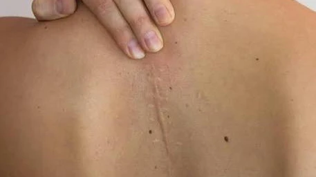 Is Surgical Scar Revision Suitable for Long-Standing Scars?