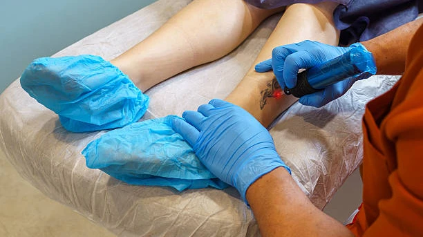 Can Laser Tattoo Removal treat professional tattoos