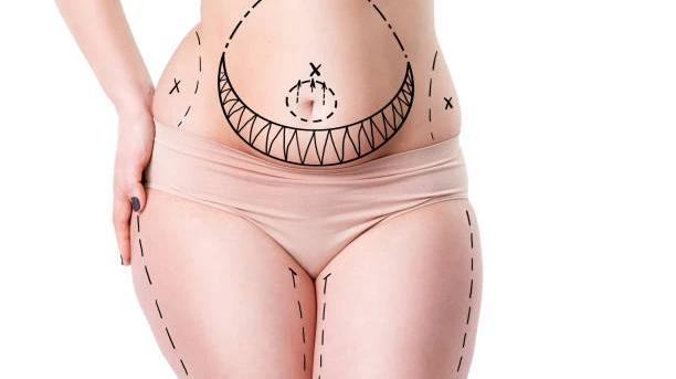 Liposuction Guide to Personalized Fat Removal Solutions