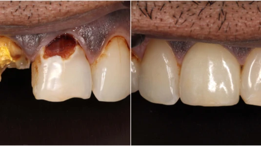 Signs You May Need a Cavity Filling Sooner Than You Think