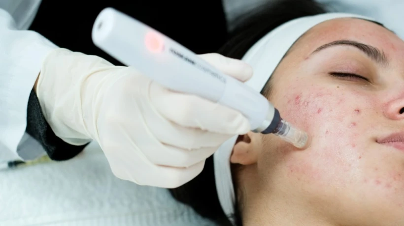 Is Microneedling Suitable for Improving Facial Skin Texture?