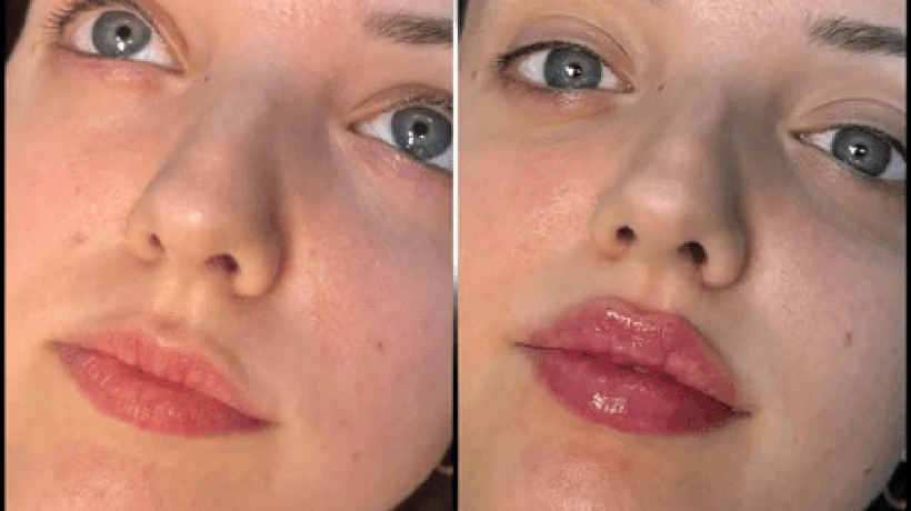 Best Aesthetic Clinic in dubai for Fillers for a Radiant Appearance