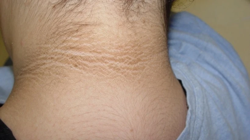 What Should You Know Before Comparing Dark Neck Treatment’s Price?