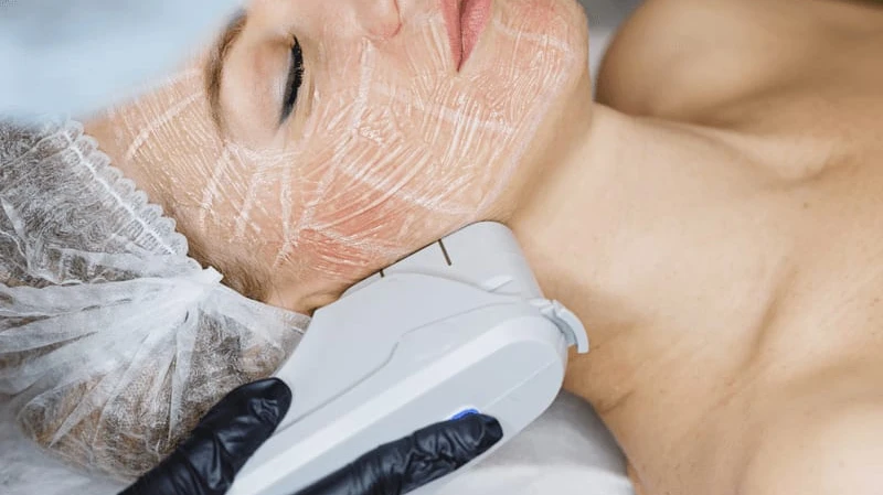 Can HIFU Treatment Cost Depend on Skin Concerns?