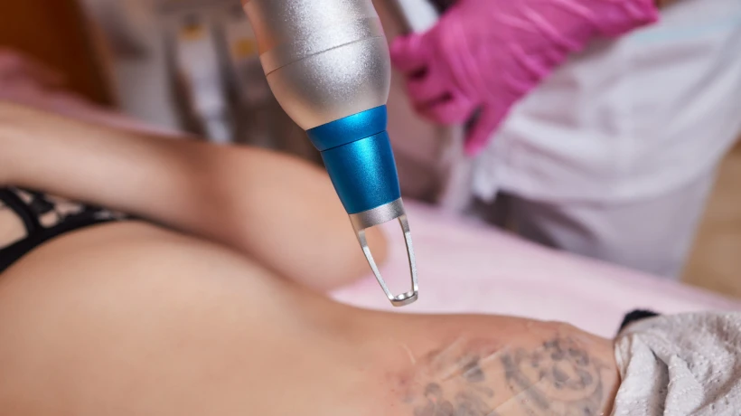 What Makes Tattoo Removal Helpful for Small Tattoo Fading?