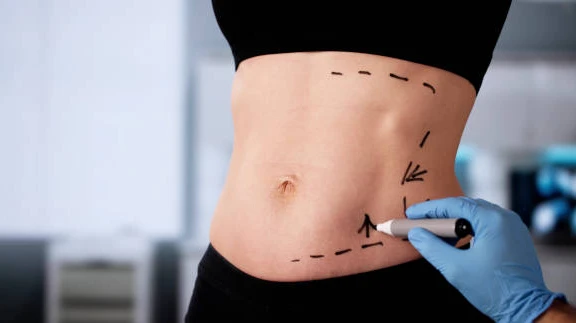 Elevate Your Body Contouring Journey with Liposuction
