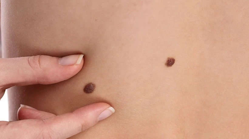 How is birthmark removal performed?