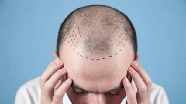Hair Transplant in Al Ain for Dubai Residents Seeking Natural Results