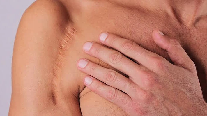 What Should You Consider Before Choosing Scar Revision Surgery?