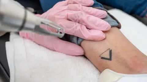Is Laser Tattoo Removal Suitable for Different Skin Types?
