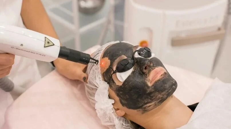 Is Laser Carbon Peel Suitable for Mildly Congested Skin?