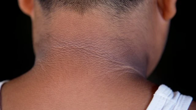 Why Does Dark Neck Treatment Price Vary Across Dubai Clinics?