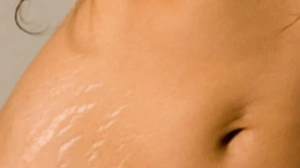 Does Stretch Marks Removal Support Smoother Looking Skin?