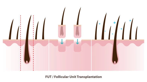 What Is FUT Hair Transplant in Dubai and How Does It Work?
