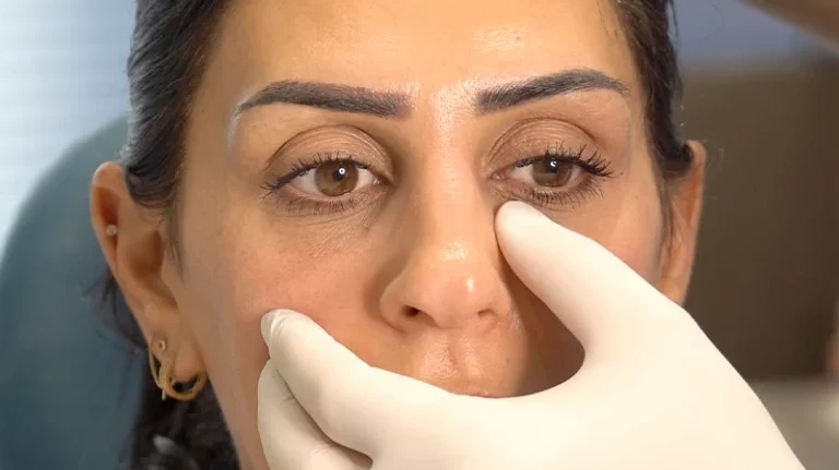 Can Tear Trough Fillers Improve the Eye-Cheek Transition?