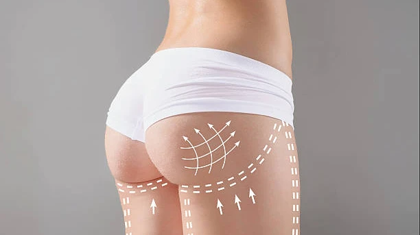 How to Prepare for a Butt Filler Appointment