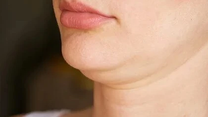 Can Surgical Double Chin Removal Define the Jaw and Neck?