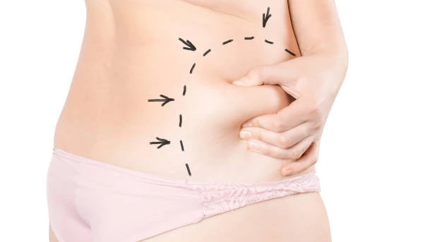 Can Laser Liposuction target stubborn love handles