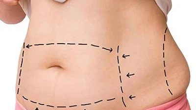 What Happens During a Personalized Liposuction Treatment?