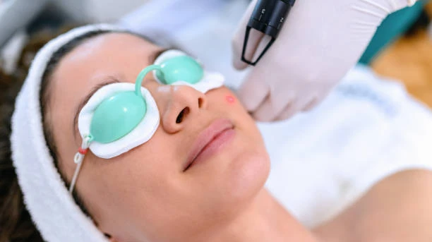 Q-Switched Laser for Tattoo Removal: How Does It Work?