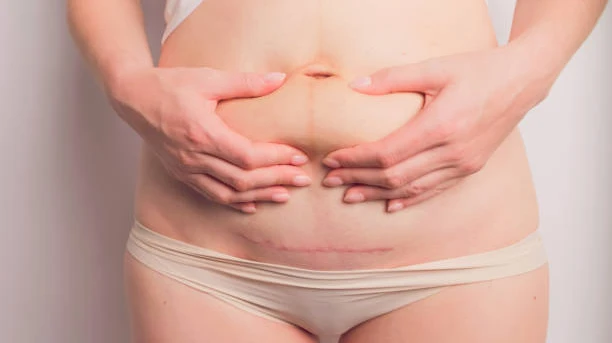 Common Questions Patients Ask Before Tummy Tuck Surgery