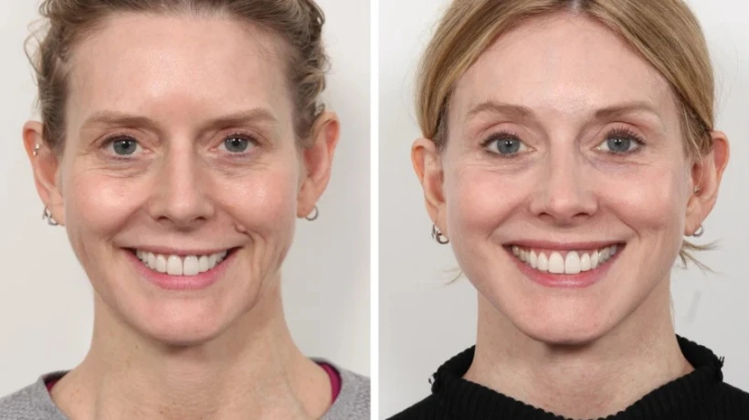 Best Plastic Surgeons in Dubai for Cheek and Jawline Thread Lift